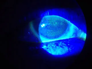 Окрашивание роговицы при тяжелом синдроме сухого глаза