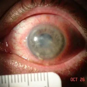 Воспаление