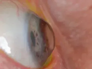 Эктазия роговицы