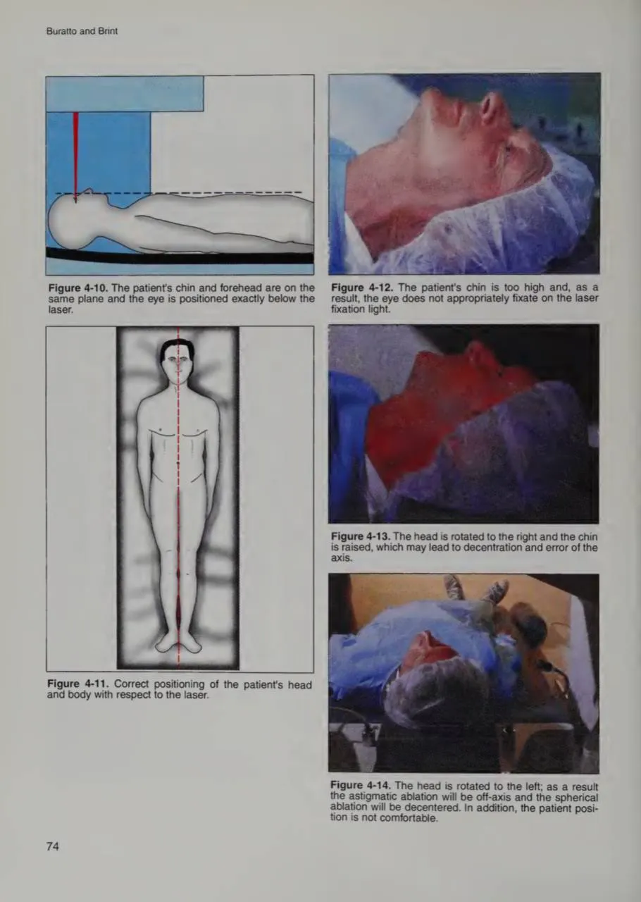 Риски движения головы во время лазерной коррекции зрения