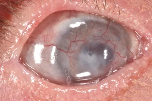 Мутный, больной глаз после осложнений LASIK