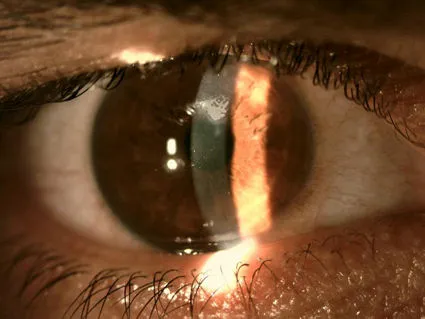 Врастание эпителия после операции SMILE