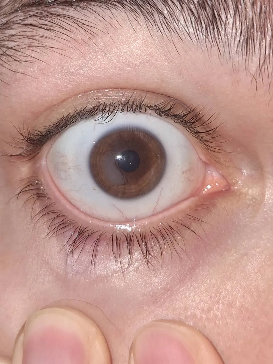 Врастание эпителия под лоскут LASIK