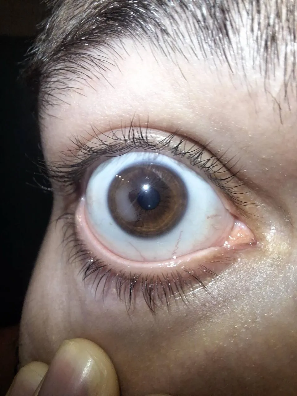 Прогрессирующее врастание эпителия