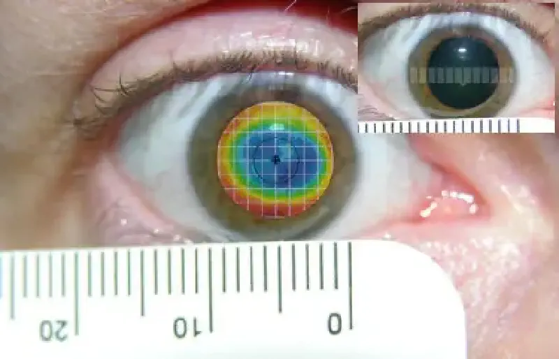 Топография роговицы пациента 2 с большими зрачками после лазерной коррекции