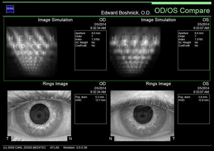 post lasik ectasia image simulation