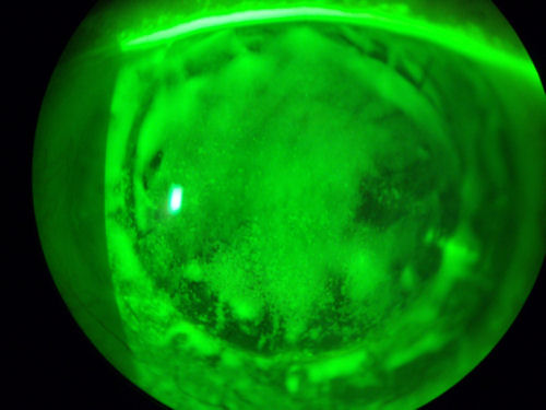 post-ALK cornea with severe dry eye