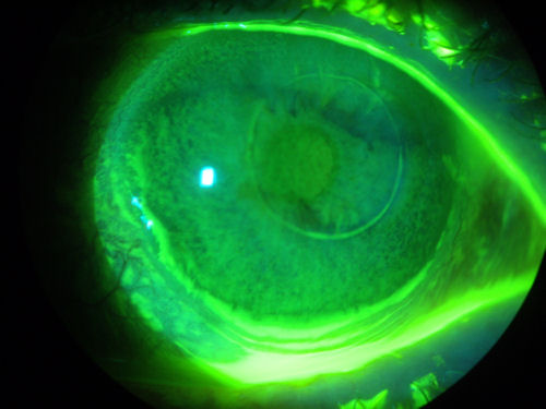 diseased post-ALK cornea