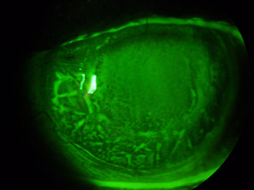 dry distorted post-ALK cornea