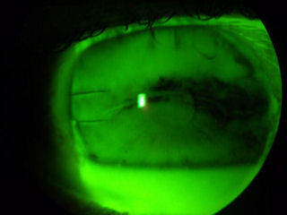 post-RK cornea with dry eye disease