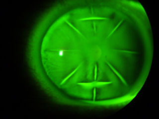 cornea with 8 radial RK incisions and 2 t-cuts