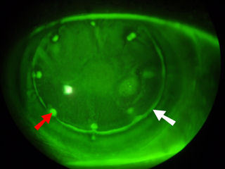 LASIK flap and CK spots
