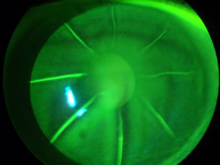 22 year-old unhealed RK incisions