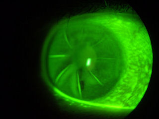 non-healed RK incisions