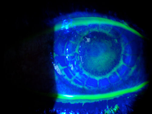 corneal transplant 2 weeks after surgery
