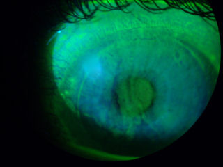 post lasik ectasia, dry eye, and epithelial ingrowth