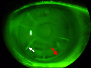 post RK post LASIK non healed RK incisions and LASIK flap