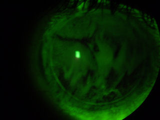 tear break up on post-LASIK eye