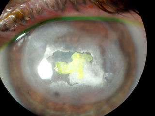 post-LASIK, ectasia, rejected transplants