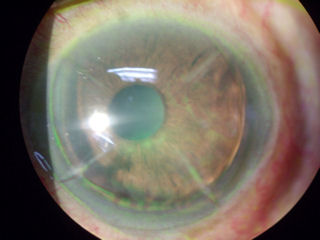 post RK post LASIK corneal neovascularization