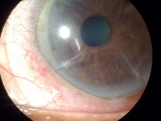 post RK, post LASIK, neovascularization