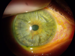 2 RK surgeries followed by 2 LASIK surgeries