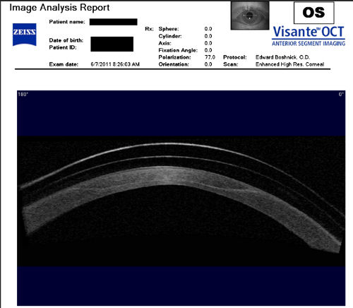 cornea post-automated lamellar keratoplasty wearing scleral lens