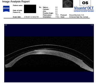 post-RK, post-LASIK cornea