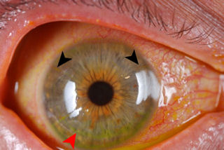 post RK post LASIK ectasia