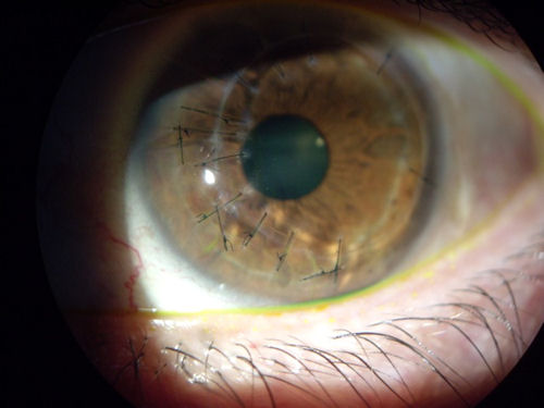 post RK, infection, transplant