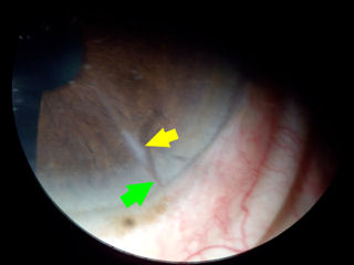 RK scar with neovascularization