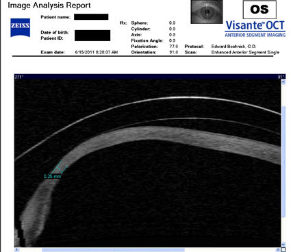 post-LASIK cornea 250 microns at thinnest point