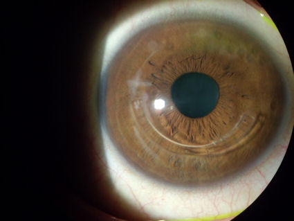 post lasik ectasia epithelial ingrowth Intacs