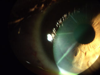 post-RK, post LASIK, ectasia