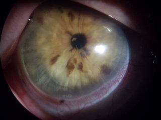 post RK, post LASIK, neovascularization