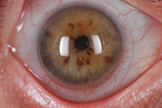 post RK, post LASIK, neovascularization