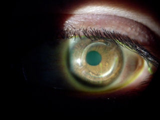 post-LASIK ectasia with INTACS