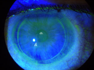 post-LASIK ectasia with INTACS