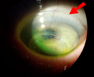 Scleral Lens on Post-Lasik/Post-PRK Transplanted Cornea with Intacs