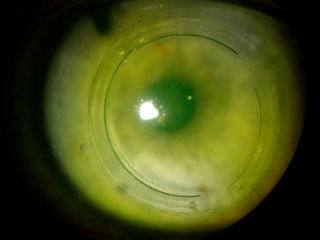 Post-Lasik/Post PRK/Transplanted Cornea with Intacs