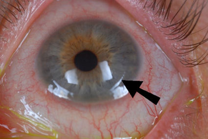 LASIK flap margin visible