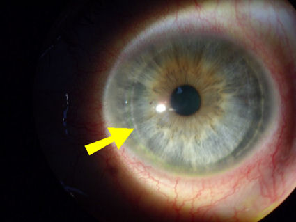 LASIK flap never heals