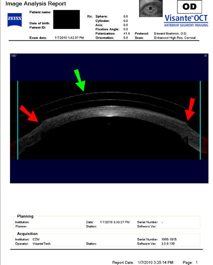 scleral lens on post-LASIK cornea with corneal damage at flap edge