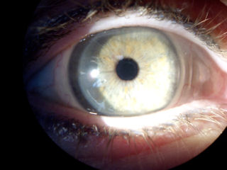 2 RK surgeries followed by 2 LASIK surgeries