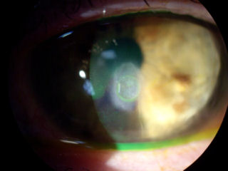 post RK bullous keratopathy