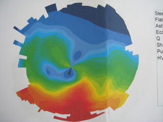 ectasia after RK and LASIK