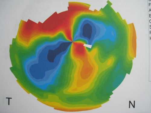 topography of corneal transplant