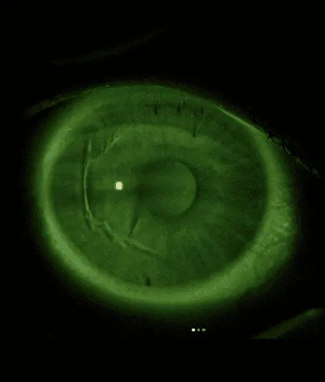 Девушка из Краснодара потеряла зрение и ослепла после LASIK